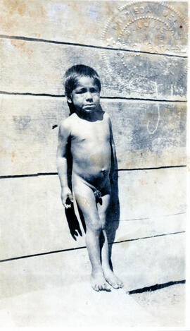 Fotografía del niño D.D. con 40 de hemoglobina. La enfermedad se refleja en la cara, especialment...