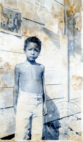 Fotografía del niño J.M con 25 de hemoglobina. Aparenta una edad de 11 años y recibió tratamiento...